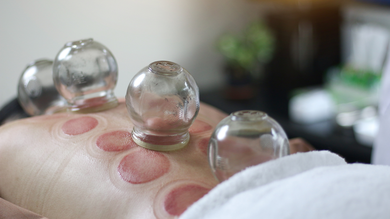 cupping